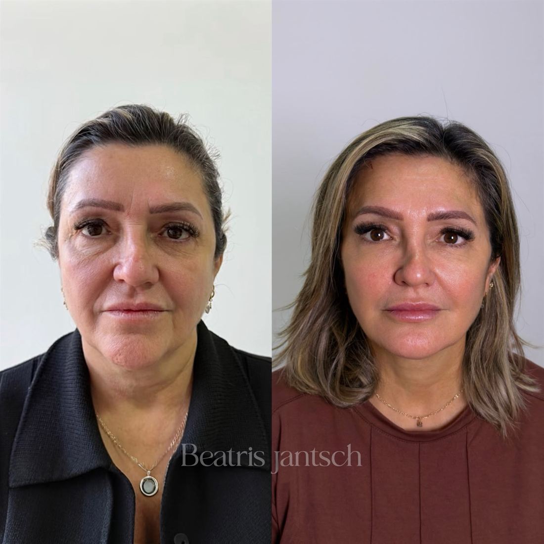 Antes e depois — caso 1