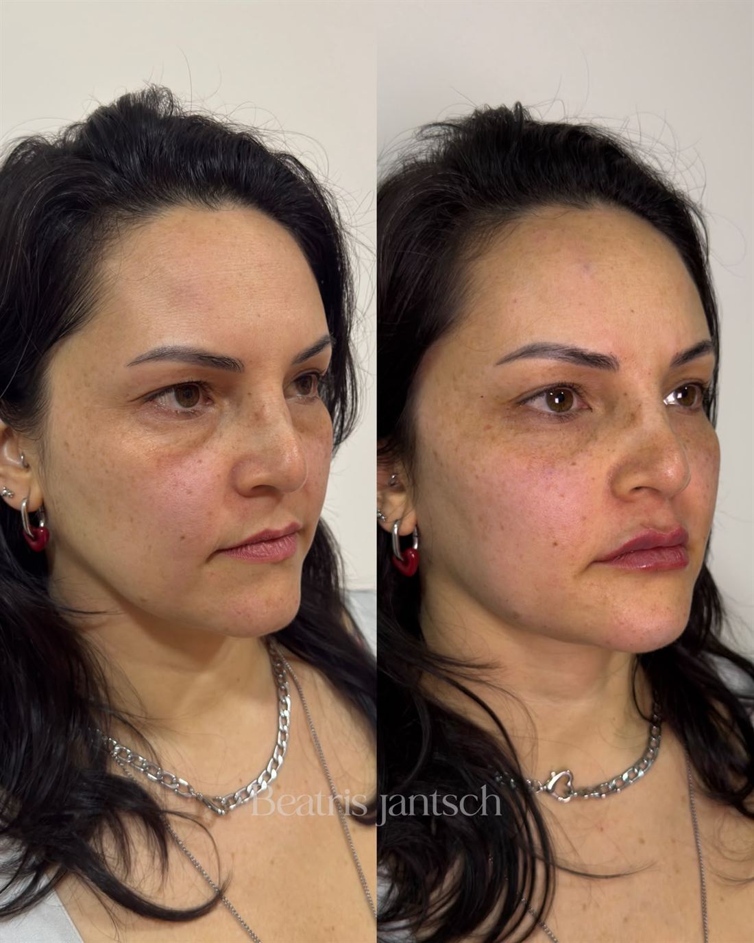 Antes e depois — caso 2