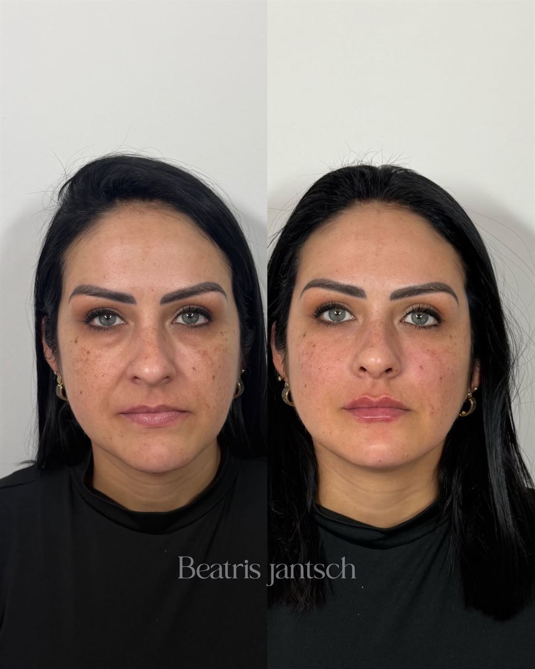 Antes e depois — caso 4