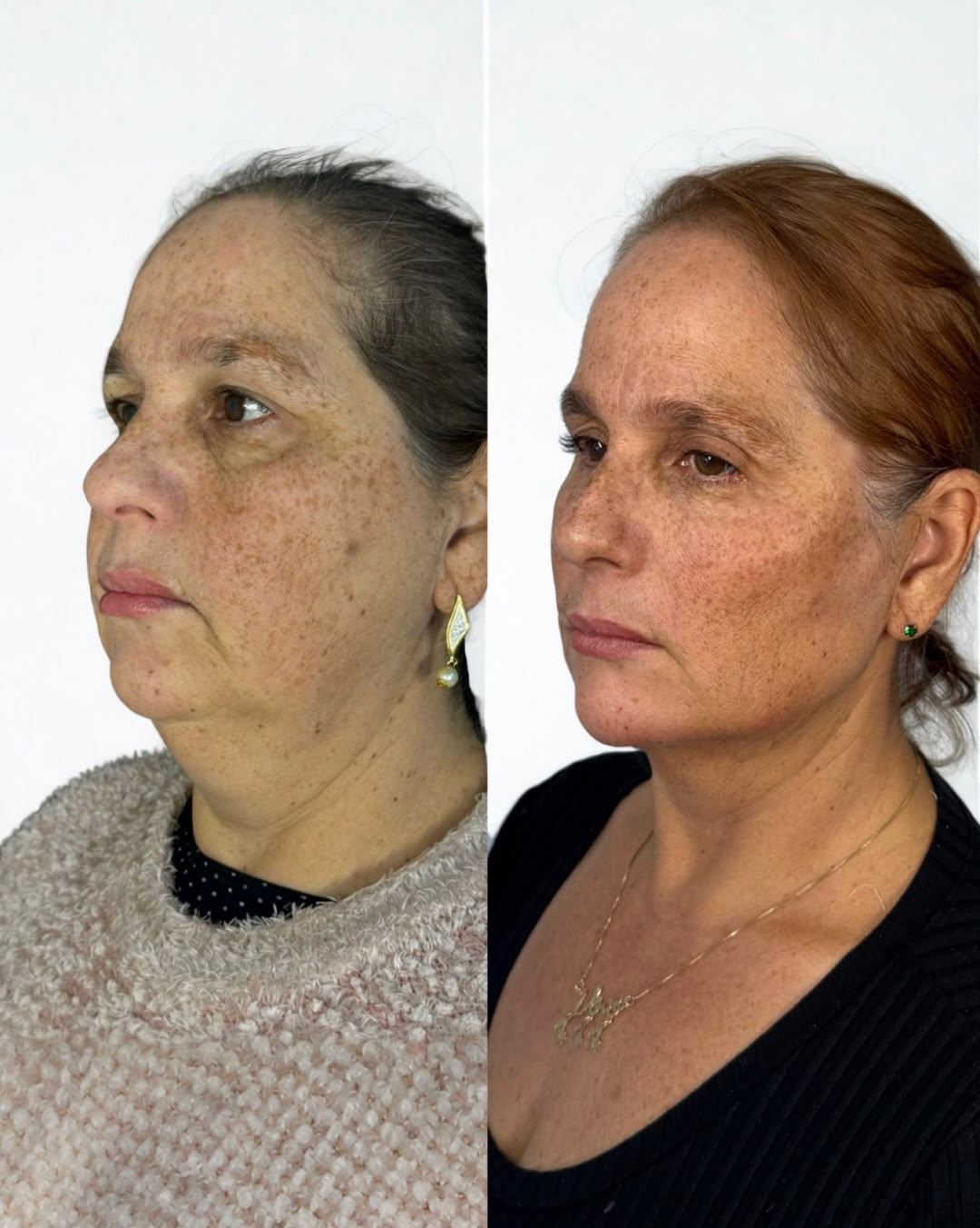 Antes e depois — caso 7