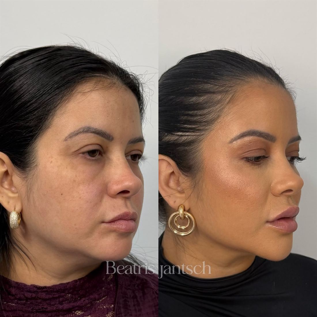 Antes e depois — caso 9